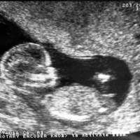 Календарь беременности: изображение плода на 15 неделе развития (ультразвук)