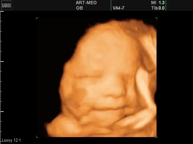 Фото 3D-УЗИ на 39 неделе беременности