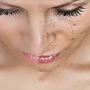Как замаскировать пигментные пятна на лице