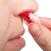 Почему идет кровь из носа у ребенка и как остановить кровотечение из носа