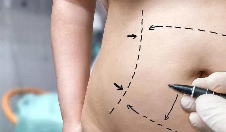 Зачем хирург рисует линии на теле перед операцией