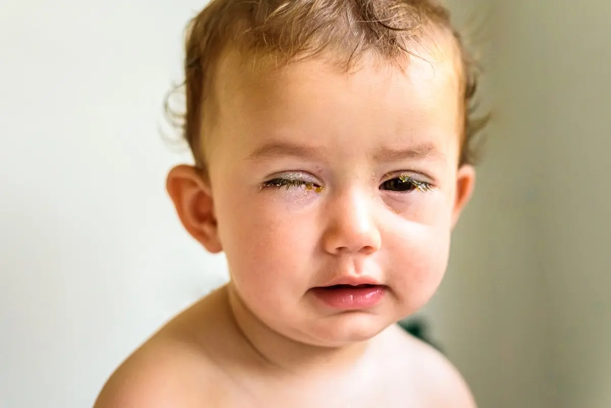 аллергический конъюнктивит у детей фото