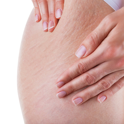 Растяжки при похудении, во время беременности: как избавиться?