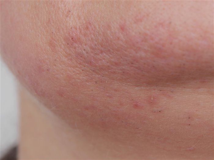 Лечение купероза кожи лица