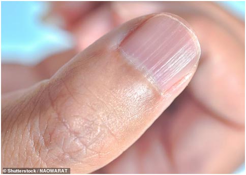 Почему возникают ребристые ногти: причины и способы лечения
