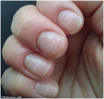 Белые пятна на ногтях: почему появляются, что означает, как удалить