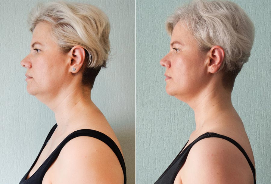 Омоложение лица, фото до и после. Ирина, 49 лет